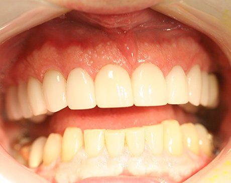 A close up of the teeth and gums