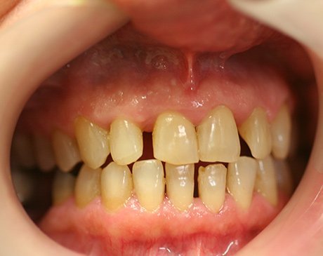 A close up of teeth with yellow and white fillings