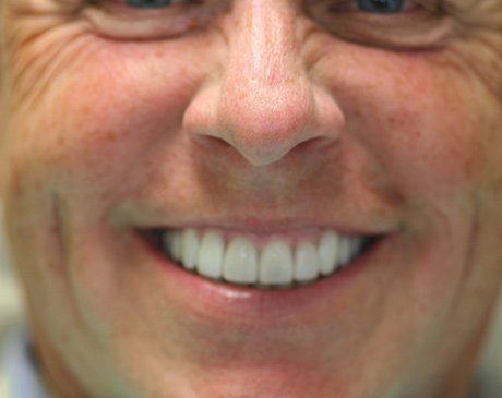 A close up of a person smiling with teeth