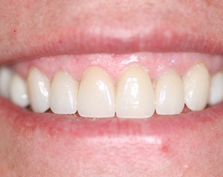 A close up of the teeth and smile of someone.