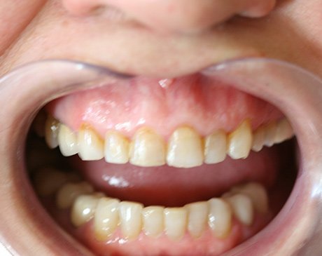 A close up of the teeth of someone with yellow teeth