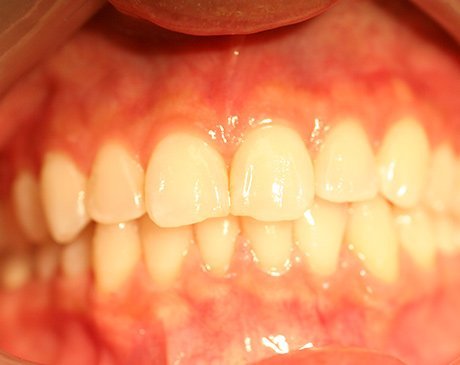 A close up of the teeth and gums