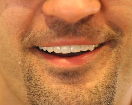 A close up of the teeth and smile of a man.