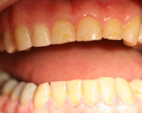 A close up of two teeth with yellow and white fillings