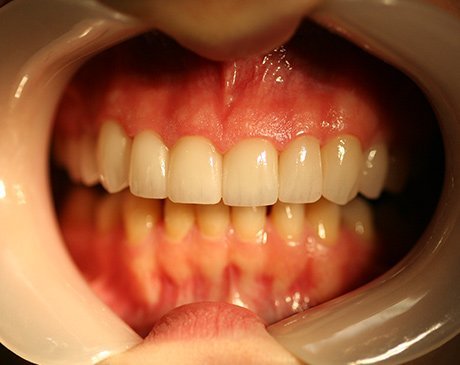 A close up of the teeth and gums