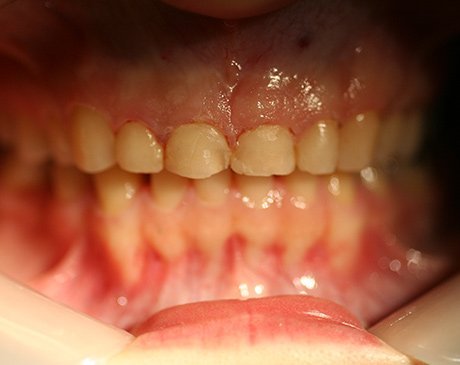 A close up of the teeth and gums